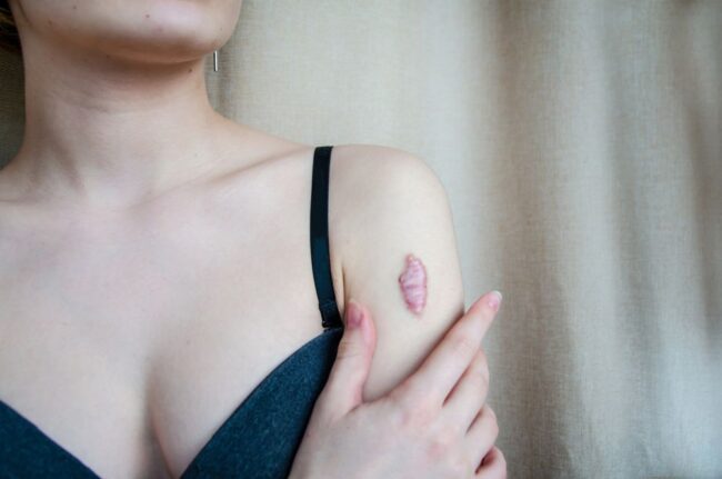 qué son los queloides