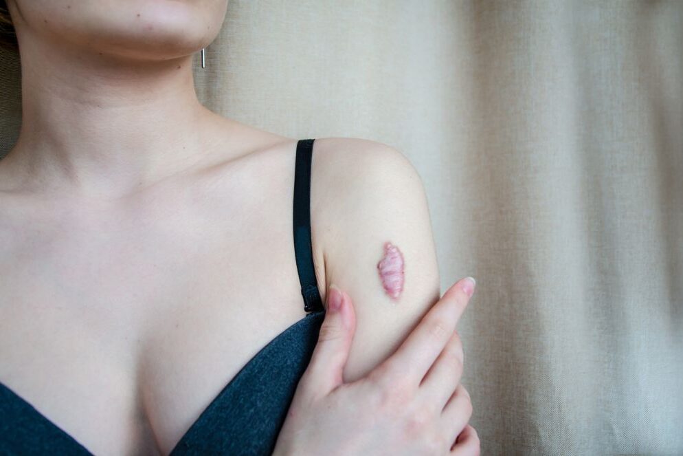 qué son los queloides